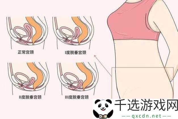 女性得阴挺病是怎么回事：原因与应对方法